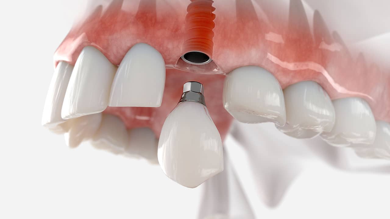 Difference between a dental implant and a dental bridge