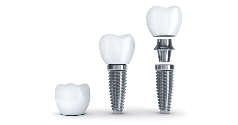 Difference Between A Dental Implant And A Dental Bridge, Distinctions of Dental Implant Versus Dental Bridge, Dental Implant vs Dental Bridge Variations, Contrasts Between Dental Implants and Bridges, Dental Bridge vs Dental Implant Differences, Dental Implant and Bridge Disparities, Dental Implant vs Bridge Distinctions, Dental Bridge Compared to Dental Implant, Dental Implant and Bridge Variances, Dental Implant vs Bridge Comparisons, Dental Bridge versus Dental Implant Analysis, Dental Implant vs Bridge Differentiations, Dental Bridge and Implant Contrasts, Dental Implant vs Dental Bridge Similarities, Dental Bridge versus Implant Discrepancies, Dental Implant and Bridge Comparatives, Dental Bridge vs Implant Variances, Dental Implant and Bridge Contrarieties, Dental Implant vs Bridge Assessment, Dental Bridge Compared with Dental Implant, Dental Implant vs Bridge Alternatives, Dental Bridge and Implant Differences, Dental Implant and Bridge Distinctive Features, Dental Bridge vs Dental Implant Aspects, Dental Implant and Bridge Comparing Points